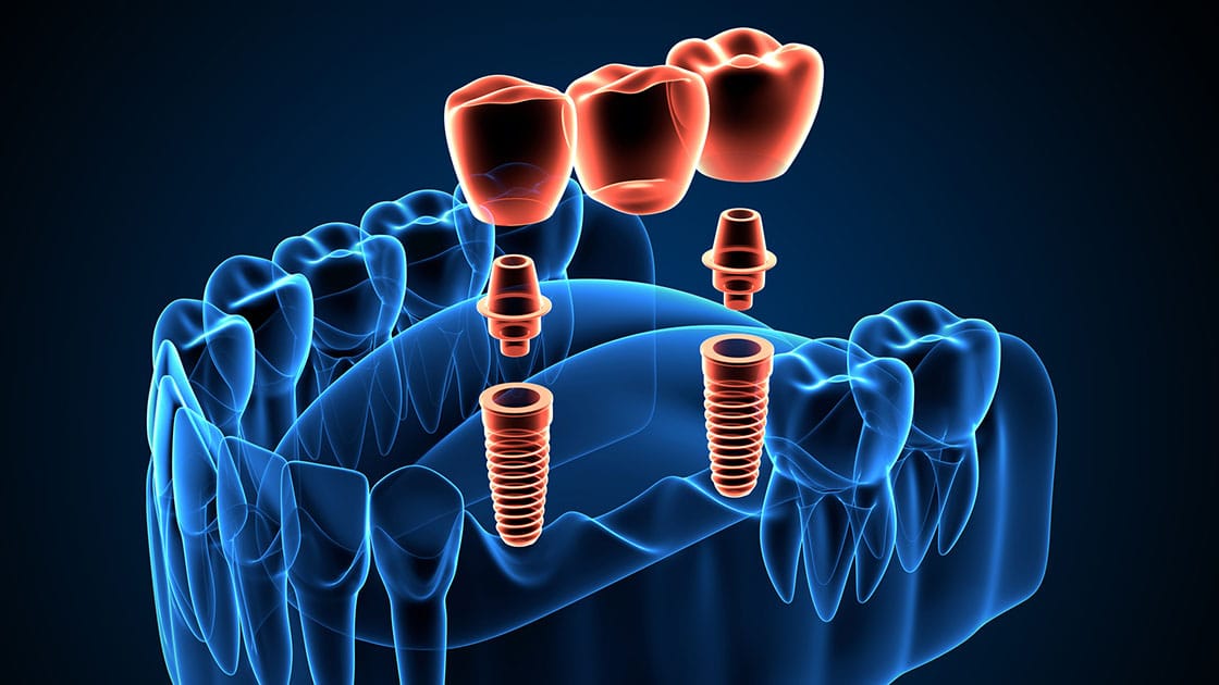 Implant Supported Bridge